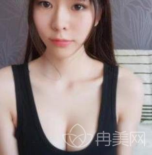 上海美莱汪灏隆胸修复经历分享，性感丰满的胸部让我更自信