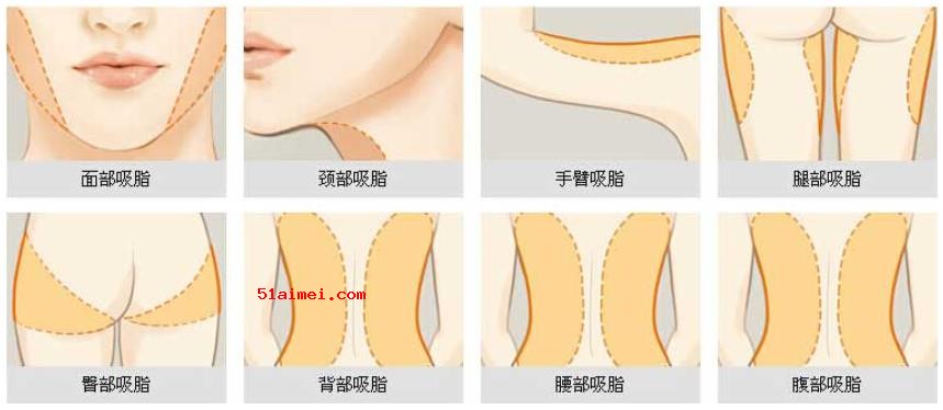 张荣明吸脂价格是多少?大腿抽脂/腰腹环吸都是15600元起