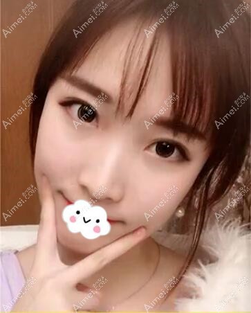 揭阳华美眼综合术后30天恢复效果图