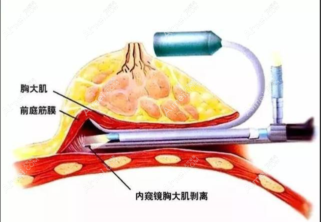 上海做隆胸排名前3整形医院:上海华美/伊莱美/薇琳丰胸出名