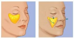 自体脂肪面部脂肪填充额头的五大要点