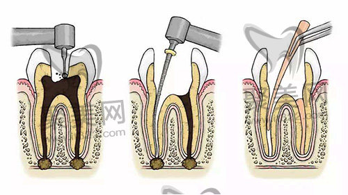 根管治疗