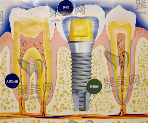 种植牙
