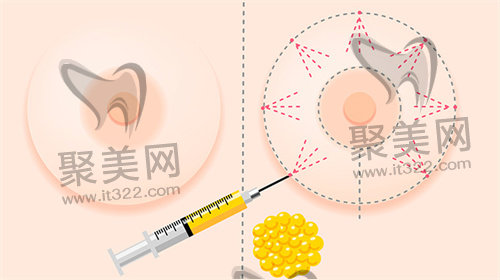 胶原蛋白丰胸