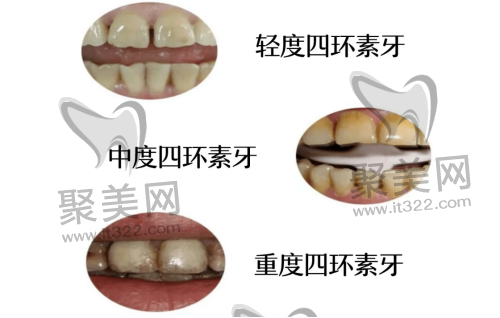 不同阶段的四环素牙