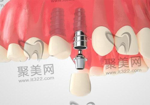 植入瑞士ITI士卓曼种植体