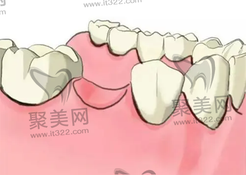 牙没了一定要种牙吗？牙没了怎么补牙，有几种修补办法呢？