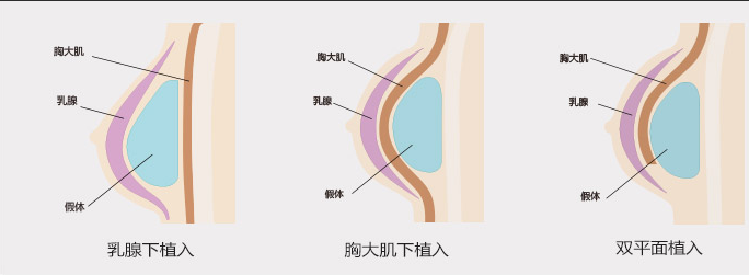 北京雅韵整形医院假体隆胸多少钱？