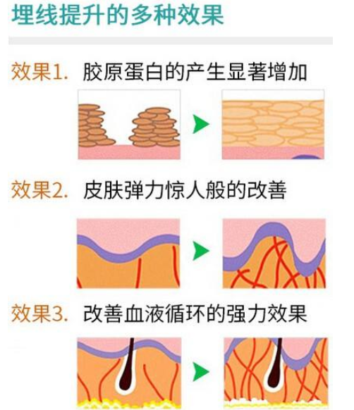 面部紧致提升的4大法门