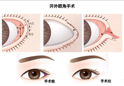 四种方法开眼角前后对比图