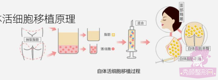 【自体脂肪】自体脂肪移植填充过程曝光