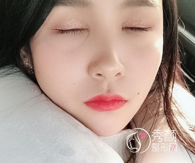 上海华美杨亚益割双眼皮开眼角恢复过程，7mm扇形真的很适合我！