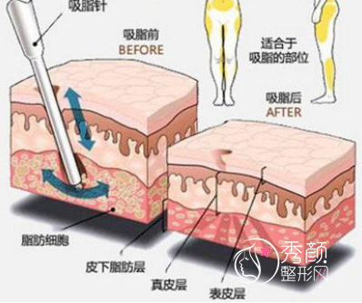 自体脂肪填充面部有风险吗?脸部脂肪填充的危害和后遗症.