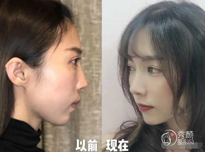 偏颌正颌手术风险大吗，有什么后遗症？