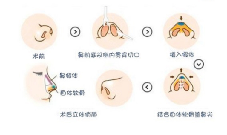 今日来谈谈做耳软骨隆鼻尖的价格是多少，隆鼻