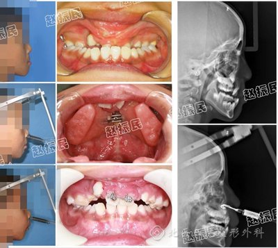 自动持续经缝牵引成骨技术矫正儿童面中部骨骼发育不全 赵振民
