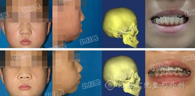 自动持续经缝牵引成骨技术矫正儿童面中部骨骼发育不全 赵振民