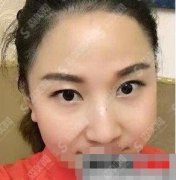 无锡人民医院美容科瘦脸针价格，通过项目让我实现了小脸之梦