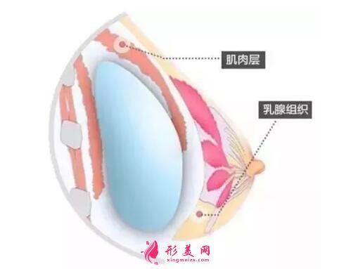 假体隆胸前需要注意的事项