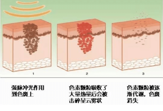 彩光嫩肤后如何保养？彩光嫩肤后的注意事项官网通报