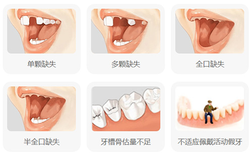 需要进行种植牙的情况