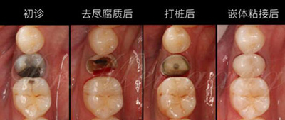 嵌体修复前后对比照片