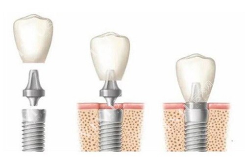 种植牙过程示意图