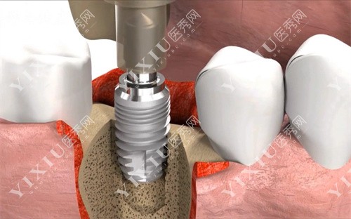 人工牙根植入图