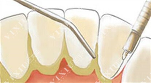 牙结石清洁图