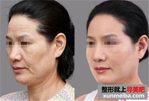 超微小气泡、复合彩光去除活性斑与水光针能一起实施吗